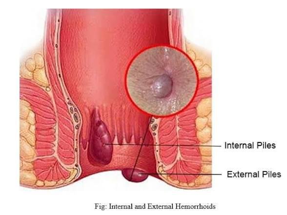 Piles (Hemorrhoids) Treatment